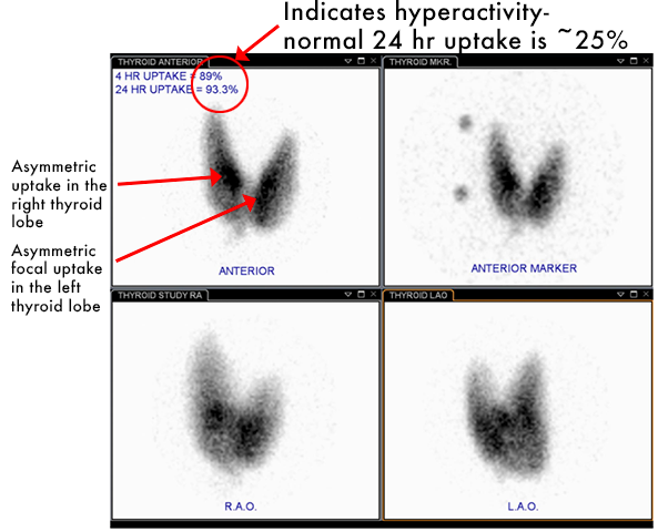 Thyroid imaging iodine-123